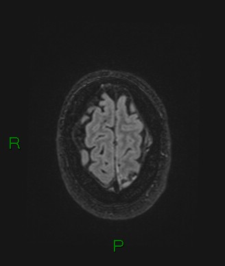 File:Cerebral abscess and subdural empyema (Radiopaedia 84436-99779 Axial FLAIR 15).jpg
