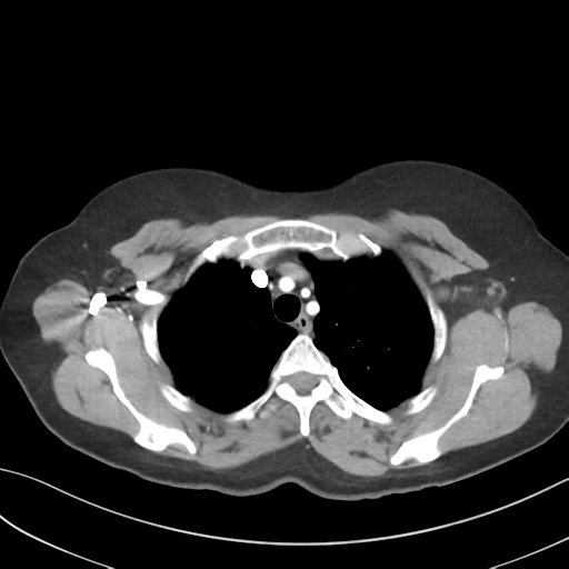 File:Cerebral abscess from pulmonary arteriovenous malformation (Radiopaedia 86275-102292 A 15).png