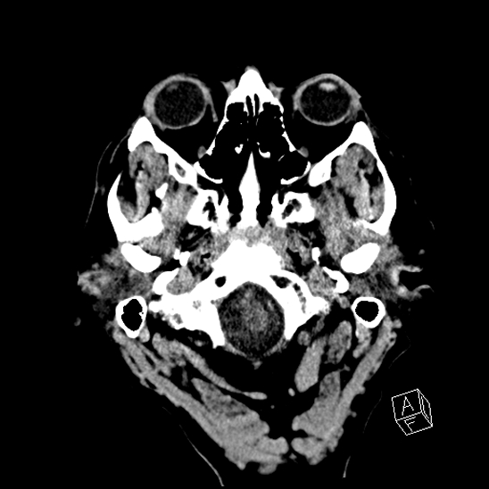 Cerebral abscess with ventriculitis (Radiopaedia 78965-91876 Axial non-contrast 7).jpg