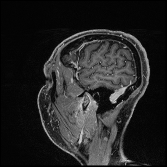 Cerebral abscess with ventriculitis (Radiopaedia 78965-91878 Sagittal T1 C+ 153).jpg