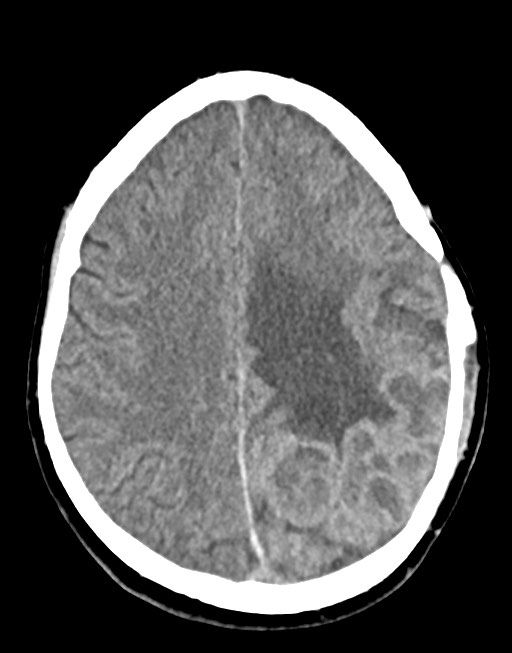 Cerebral abscesses (Radiopaedia 70458-80568 Axial non-contrast 42).jpg