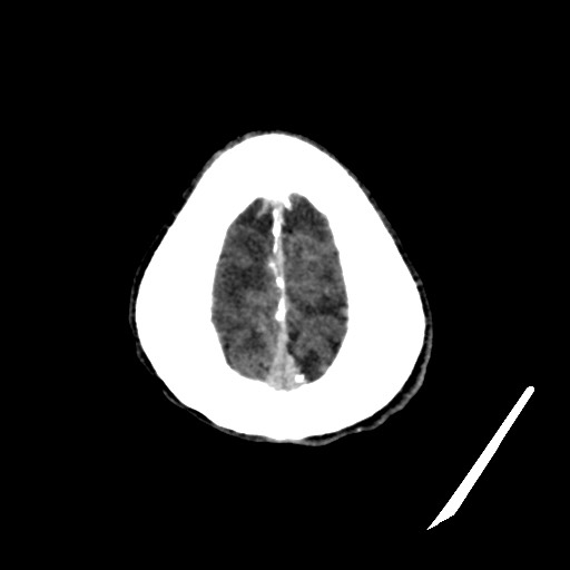 File:Cerebral amyloid angiopathy-related inflammation (Radiopaedia 74836-85848 Axial non-contrast 56).jpg