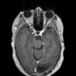 Cerebral amyloid angiopathy (Radiopaedia 29129-29518 Axial T1 C+ 58).jpg