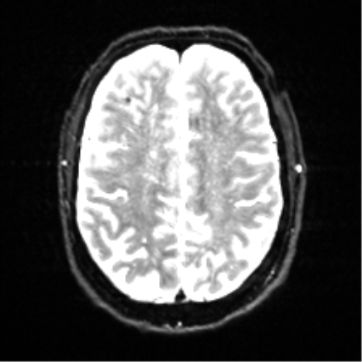 Cerebral amyloid angiopathy (Radiopaedia 46082-50433 Axial DWI 19).png