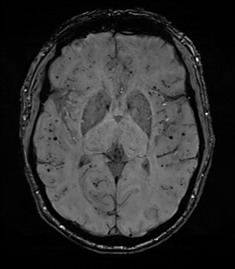 File:Cerebral amyloid angiopathy (Radiopaedia 46082-50433 Axial SWI 42).png
