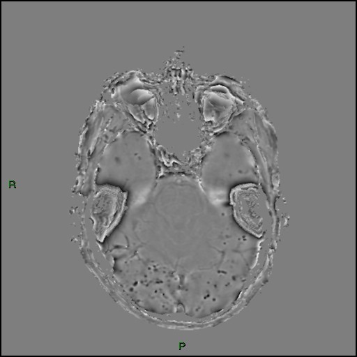 Cerebral amyloid angiopathy (Radiopaedia 77506-89664 H 36).jpg