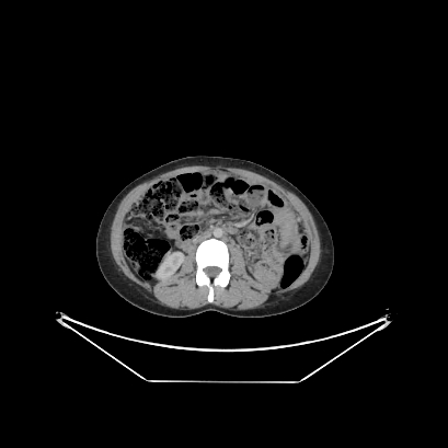 File:Cerebral and abdominal tuberculosis (PET-CT) (Radiopaedia 90499-107853 Axial 73).jpg