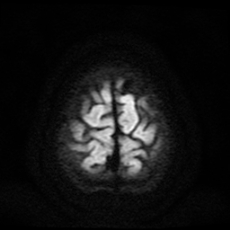 File:Cerebral and spinal tuberculosis (Radiopaedia 90489-107837 Axial DWI 20).jpg