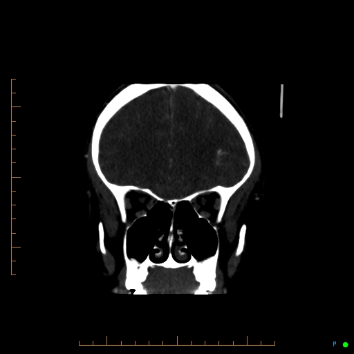 Cerebral arteriovenous malformation (AVM) (Radiopaedia 78162-90706 Coronal CTA 76).jpg