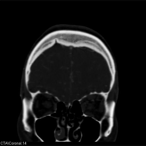 Cerebral arteriovenous malformation (Radiopaedia 28518-28759 C 14).jpg