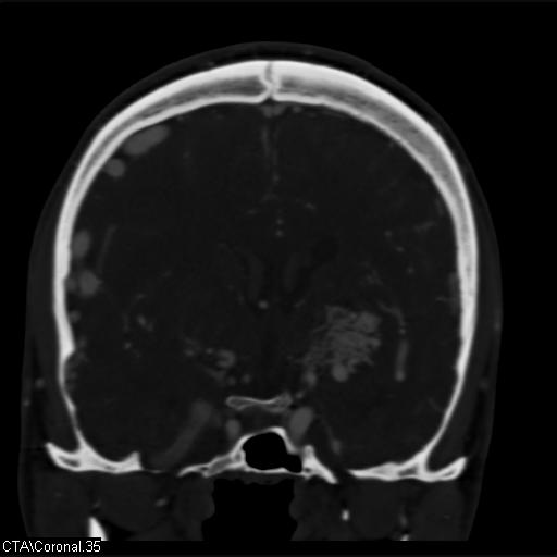Cerebral arteriovenous malformation (Radiopaedia 28518-28759 C 35).jpg