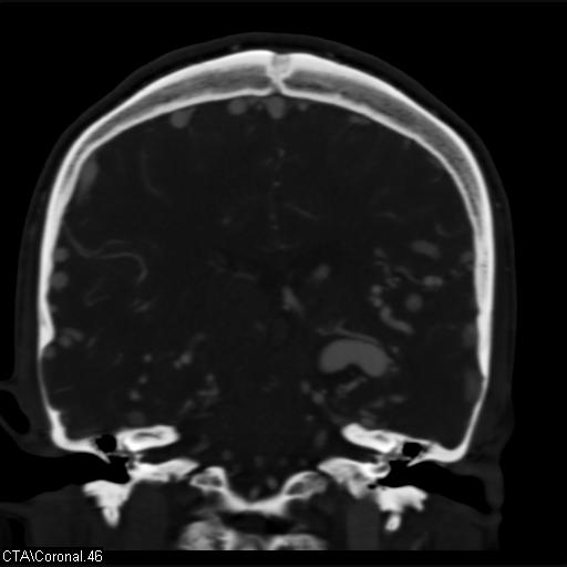 File:Cerebral arteriovenous malformation (Radiopaedia 28518-28759 C 46).jpg