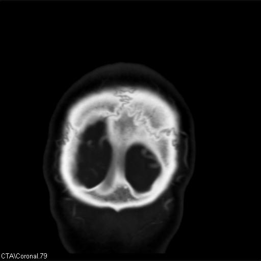 Cerebral arteriovenous malformation (Radiopaedia 28518-28759 C 79).jpg