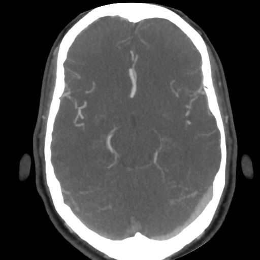 Cerebral arteriovenous malformation (Radiopaedia 39259-41505 AX CEREBRAL CTA 24).png