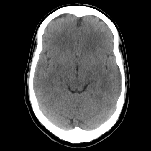 File:Cerebral arteriovenous malformation (Radiopaedia 39259-41505 Brain Ax 5mm 11).png