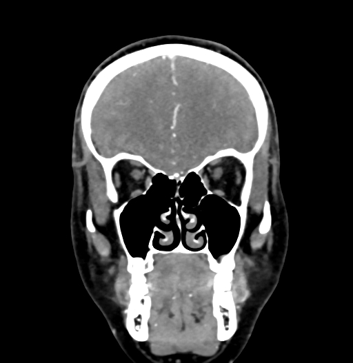 File:Cerebral arteriovenous malformation (Radiopaedia 73830-84645 C 24).jpg