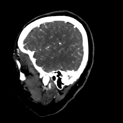 Cerebral arteriovenous malformation (Radiopaedia 73830-84645 Sagittal C+ delayed 15).jpg