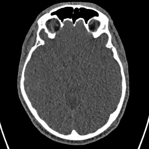 Cerebral arteriovenous malformation (Radiopaedia 78188-90746 Axial non-contrast 74).jpg