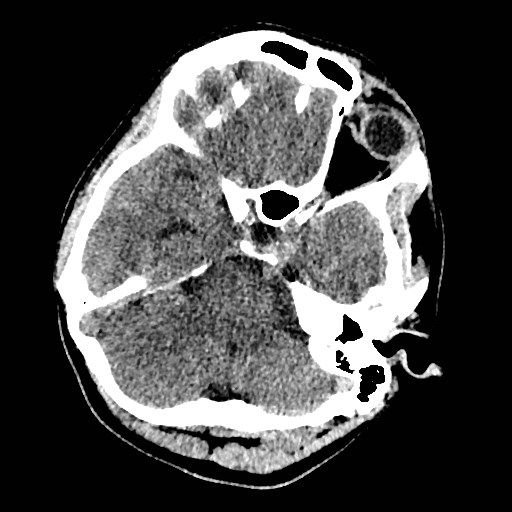 Cerebral arteriovenous malformation (Radiopaedia 79677-92887 Axial non-contrast 7).jpg