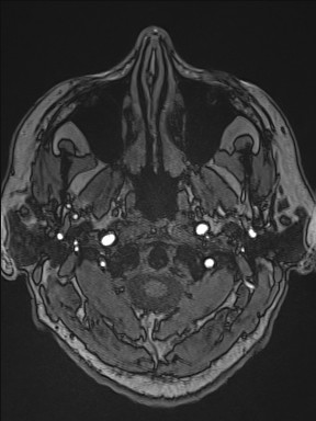Cerebral arteriovenous malformation (Radiopaedia 84015-99245 Axial TOF 26).jpg