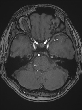 File:Cerebral arteriovenous malformation (Radiopaedia 84015-99245 Axial TOF 81).jpg