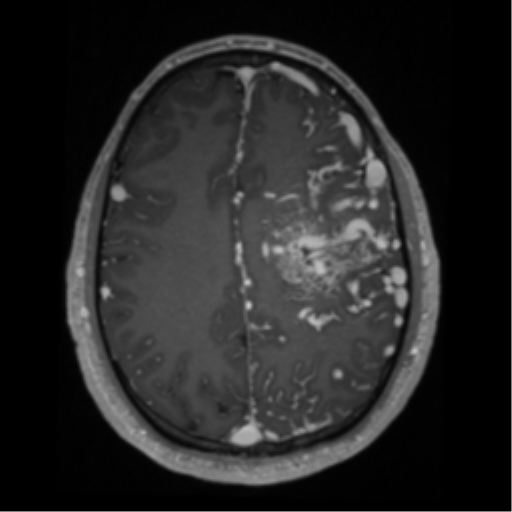 Cerebral arteriovenous malformation - huge (Radiopaedia 35734-37272 Axial T1 C+ 51).png