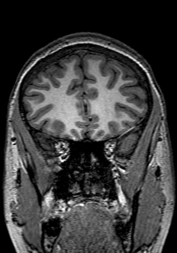 Cerebral arteriovenous malformation at posterior body of corpus callosum (Radiopaedia 74111-84925 Coronal T1 72).jpg