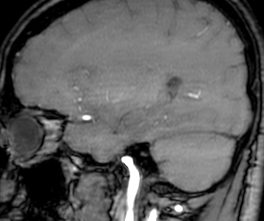 Cerebral arteriovenous malformation at posterior body of corpus callosum (Radiopaedia 74111-84925 J 106).jpg