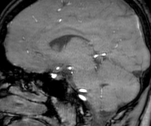 Cerebral arteriovenous malformation at posterior body of corpus callosum (Radiopaedia 74111-84925 J 216).jpg