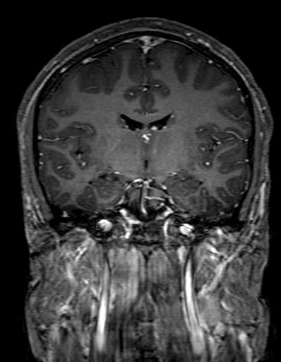 Cerebral arteriovenous malformation at posterior body of corpus callosum (Radiopaedia 74111-84925 K 179).jpg