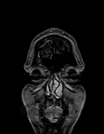 Cerebral arteriovenous malformation at posterior body of corpus callosum (Radiopaedia 74111-84925 K 6).jpg
