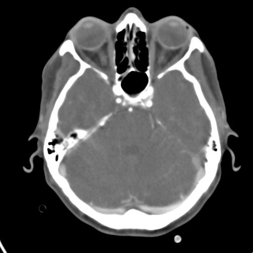 Cerebral arteriovenous malformation with hemorrhage (Radiopaedia 28773-29073 A 38).jpg