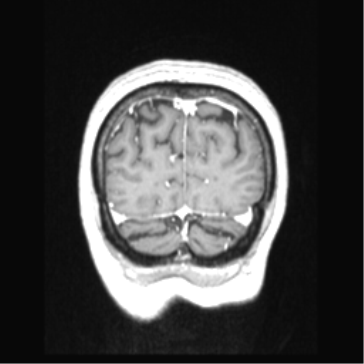 Cerebral arteriovenous malformation with hemorrhage (Radiopaedia 34422-35737 Coronal T1 C+ 15).png