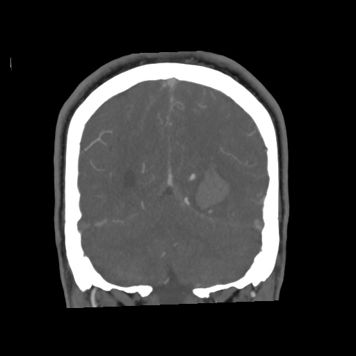 Cerebral arteriovenous malformation with lobar hemorrhage (Radiopaedia 35598-57216 C 71).jpg