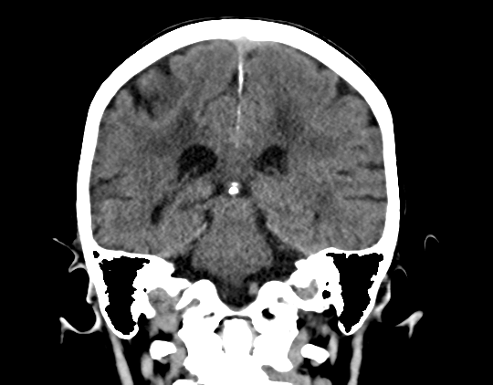 Cerebral arteriovenous malformation with lobar hemorrhage (Radiopaedia 44725-48510 Coronal non-contrast 31).png