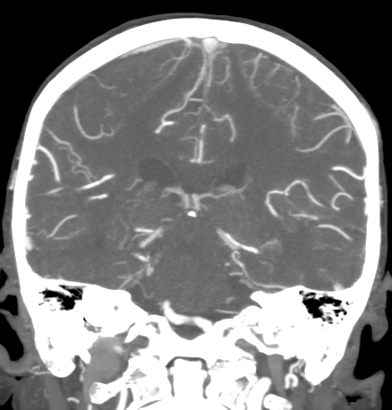 Cerebral arteriovenous malformation with lobar hemorrhage (Radiopaedia 44725-48511 B 35).png