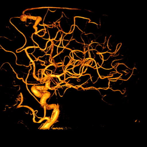 Cerebral arteriovenous malformation with lobar hemorrhage (Radiopaedia 44725-48513 Lateral 29).png