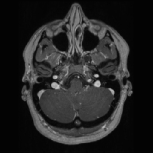 Cerebral cavernoma and development venous anomaly (Radiopaedia 37603-39482 Axial T1 C+ 16).png
