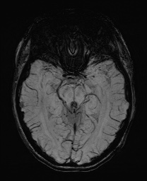 Cerebral cavernous venous malformation (Radiopaedia 70008-80021 Axial SWI 28).jpg
