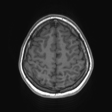 File:Cerebral cavernous venous malformation (Radiopaedia 70008-80021 Axial T1 71).jpg