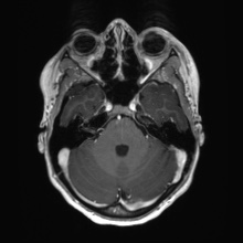 Cerebral cavernous venous malformation (Radiopaedia 70008-80021 Axial T1 C+ 18).jpg