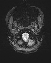 Cerebral cavernous venous malformation (Radiopaedia 70008-80021 I 3).jpg