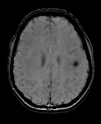 Cerebral cavernous venous malformation (Radiopaedia 70008-80021 I 49).jpg
