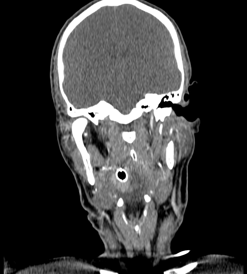 Cerebral edema in an overdose patient (Radiopaedia 72005-82539 B 55).jpg