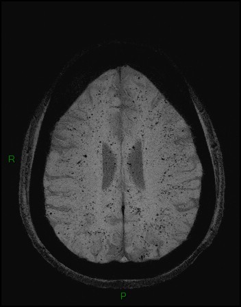 Cerebral fat embolism (Radiopaedia 35022-36525 Axial SWI 37).jpg
