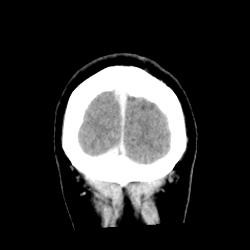 Cerebral hemorrhage secondary to arteriovenous malformation (Radiopaedia 33497-34561 C 62).png