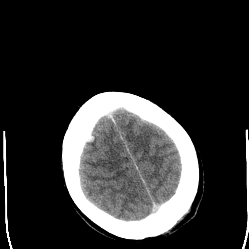 File:Cerebral hemorrhagic contusions- temporal evolution (Radiopaedia 40224-42752 Axial non-contrast 25).png