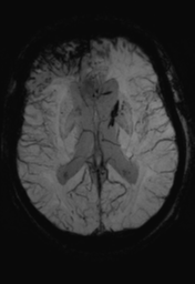 File:Cerebral hemorrhagic contusions- temporal evolution (Radiopaedia 40224-42757 Axial SWI 18).png