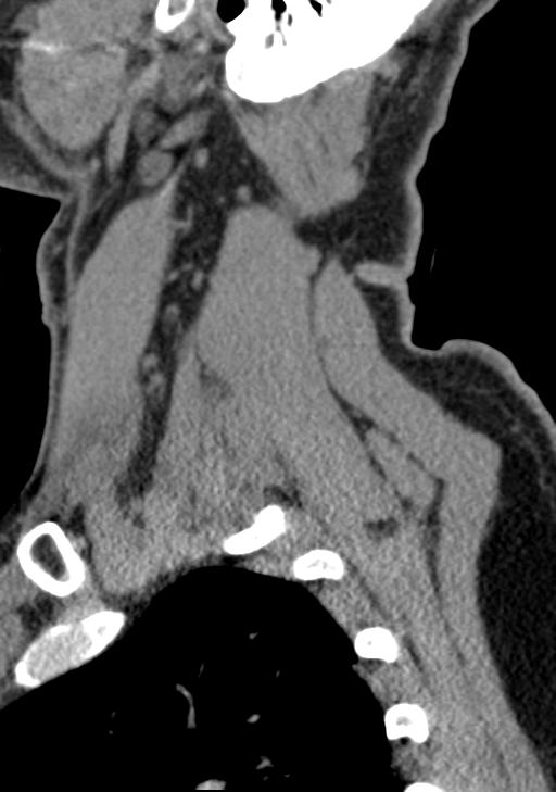 Cerebral hemorrhagic contusions and cervical spine fractures (Radiopaedia 32865-33841 G 22).jpg