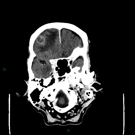 File:Cerebral metastases - breast primary (Radiopaedia 77653-89857 Axial C+ delayed 25).jpg